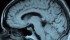 A brain scan can help with diagnosis of dementia. The Rural and Remote Memory Clinic can then follow up with patients remotely via video conferencing. | File photo