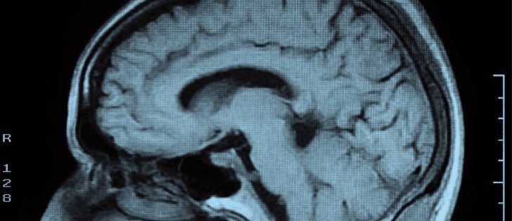 A brain scan can help with diagnosis of dementia. The Rural and Remote Memory Clinic can then follow up with patients remotely via video conferencing.  |  File photo