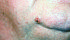 Basal cell carcinoma appears as a small bump and can be surgically removed. | Canadian dermatology association photo