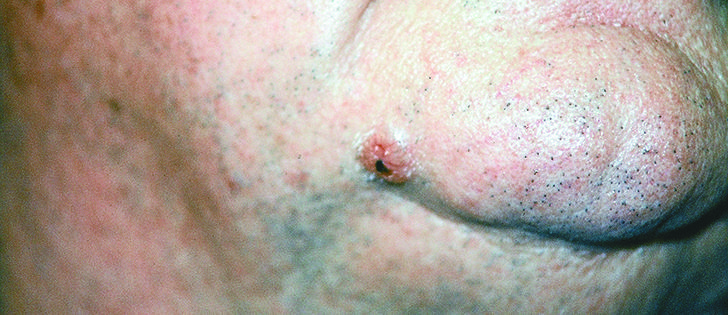 Basal cell carcinoma appears as a small bump and can be surgically removed. | Canadian dermatology association photo