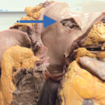 Some of the adaptations that make horses so athletic probably predispose them to fatal injuries such as this ruptured aorta, which is a major blood vessel. | University of Calgary Veterinary Medicine photo