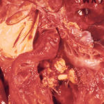 S. suis infection in weaned pigs can result in heart valve infections that cause lesions, which vets often call “cauliflower heart,” seen here in the middle of the photo. Blood backs up into the lungs, resulting in congestive heart failure. | Western College of Veterinary Medicine/Dr. Ted Clark photo