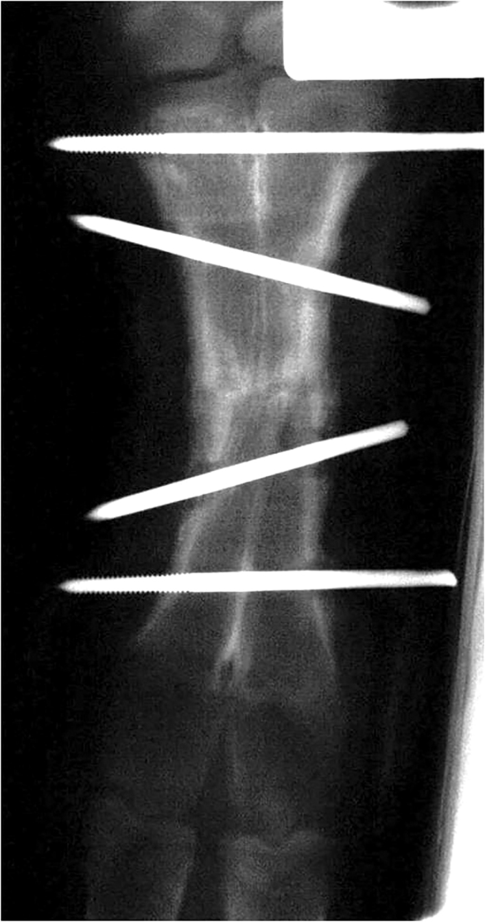 An X-ray image shows a fractured calf leg that has been pinned.