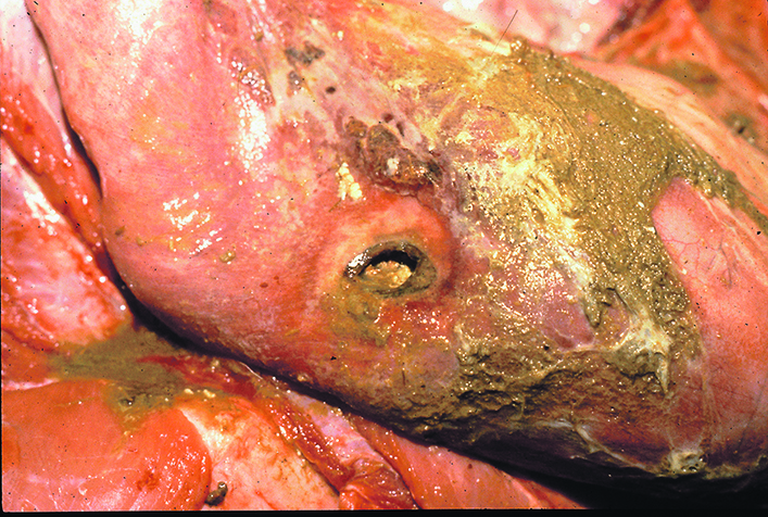 perforated ulcer