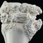 In this severely arthritic knee joint from a horse, the rough bone is a response to cartilage damage. | Jamie Rothenburger photo