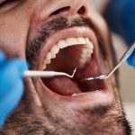 A close-up of a man's wide-open mouth with the blue, latex-gloved hands of a dentist holding two dental tools, about to work on his teeth.