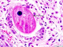 An arrow highlights a single-celled protozoan parasite called Balantoides coli as viewed under a microscope.